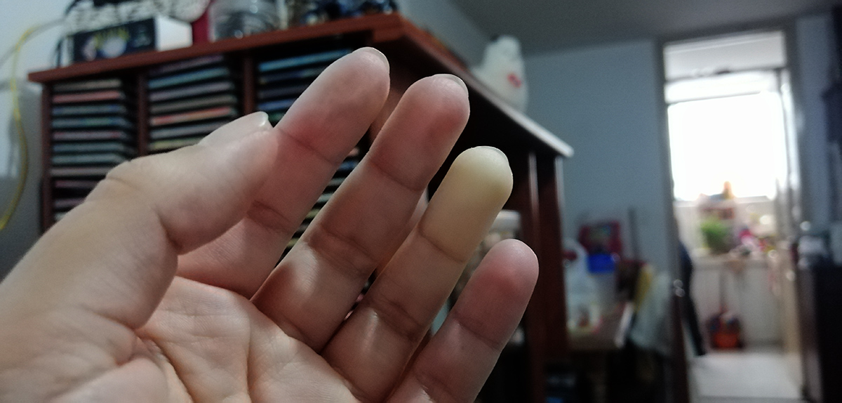 esclerodermia